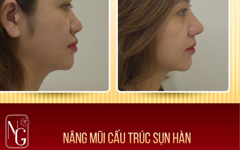 Nâng Mũi Cấu Trúc Mới Giúp Nâng Cấp Dáng Mũi Bền Lâu