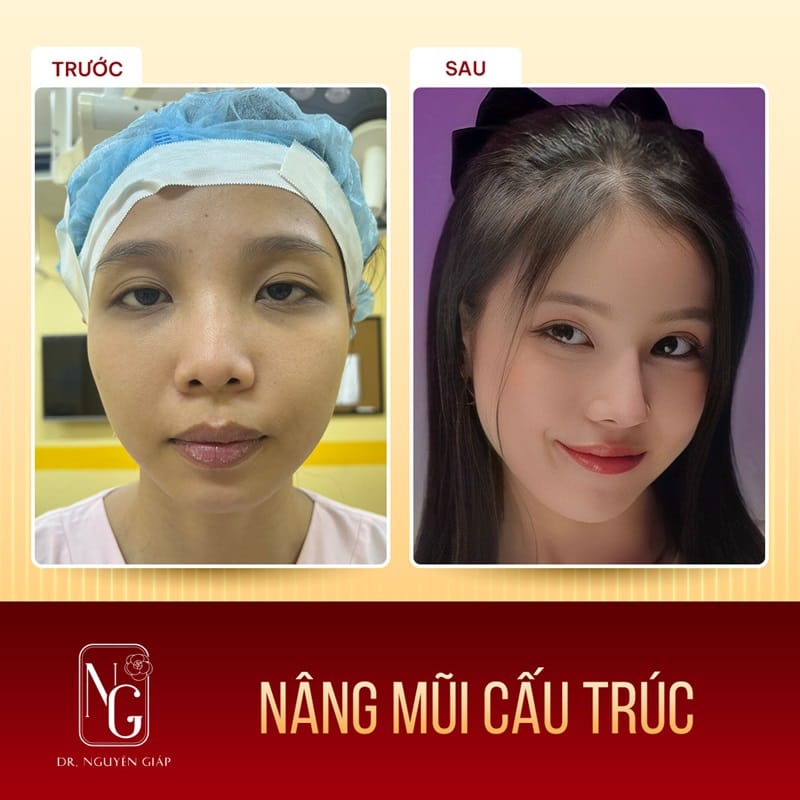 Client pictures before and after rhinoplasty new structure at Clinic Dr Nguyen Giap