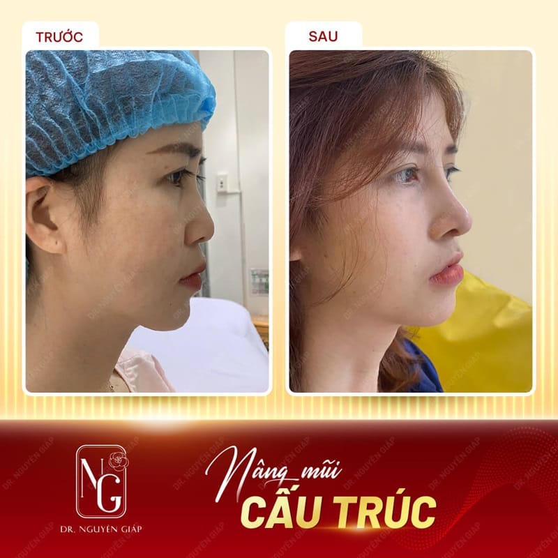 Hình ảnh khách hàng trước và sau khi thực hiện nâng mũi cấu trúc mới tại Phòng Khám Dr Nguyên Giáp