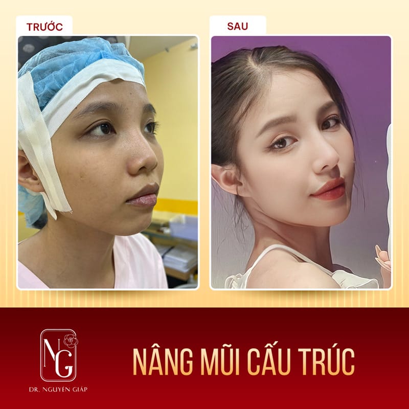 Hình ảnh khách hàng trước và sau khi thực hiện nâng mũi cấu trúc mới tại Phòng Khám Dr Nguyên Giáp