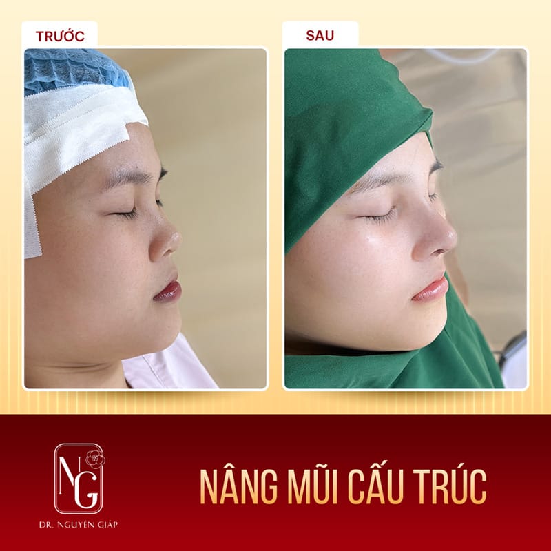 Đối tượng nên nâng mũi cấu trúc mới