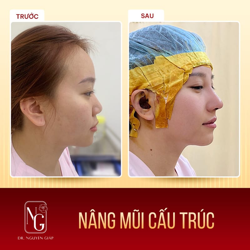 Ưu điểm của công nghệ nâng mũi cấu trúc mới tại Phòng Khám Dr Nguyên Giáp