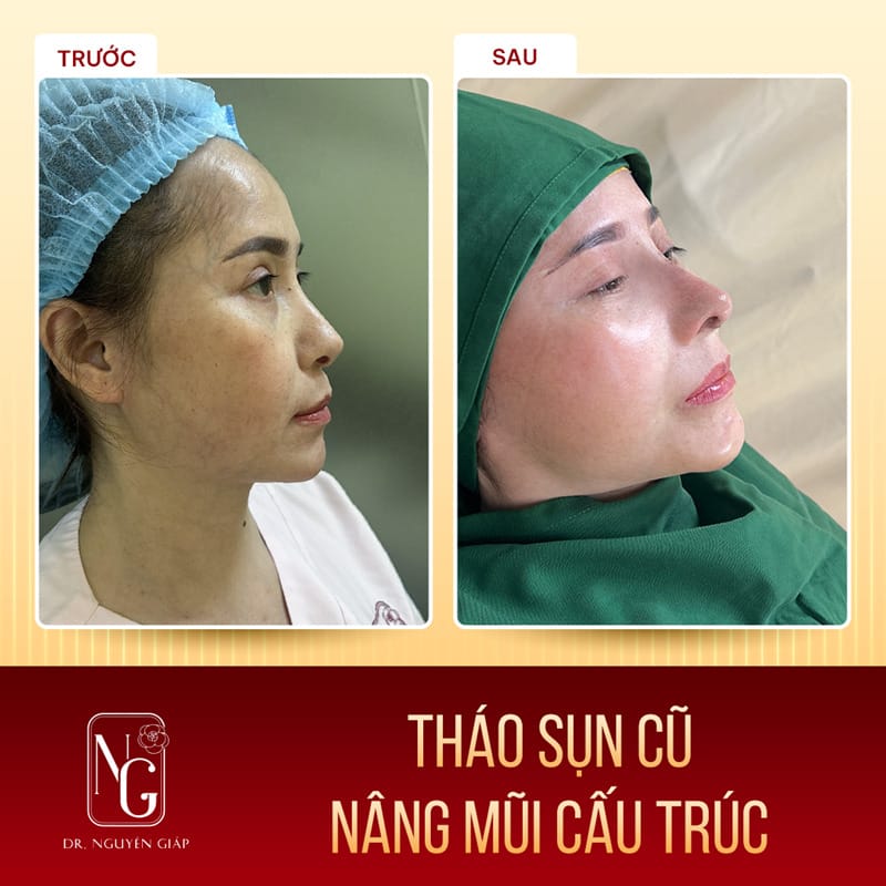 Image clients first with after rhinoplasty structure, re-edit, at the Clinic, Dr Nguyen Giap