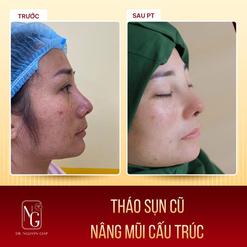 Image clients first with after rhinoplasty structure, re-edit, at the Clinic, Dr Nguyen Giap