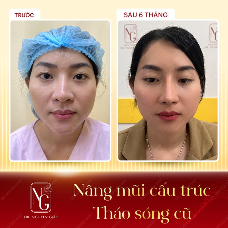 Image clients first with after rhinoplasty structure, re-edit, at the Clinic, Dr Nguyen Giap