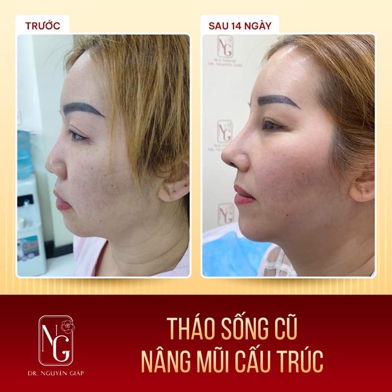 Advantages of the method of rhinoplasty, structure, revise