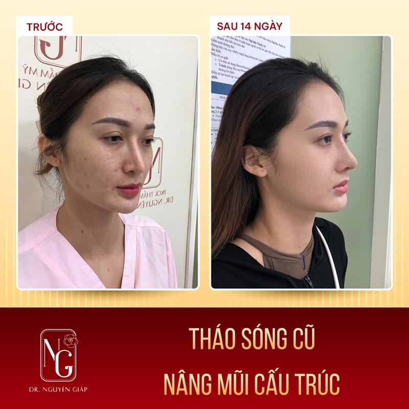 Advantages of the method of rhinoplasty, structure, revise