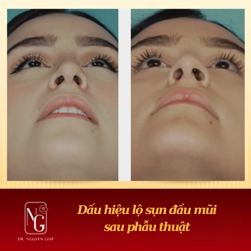 Lộ sụn đầu mũi là gì?