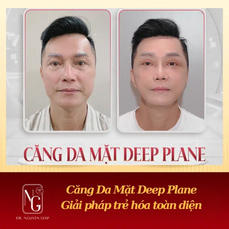 Facelift, deep plane what is