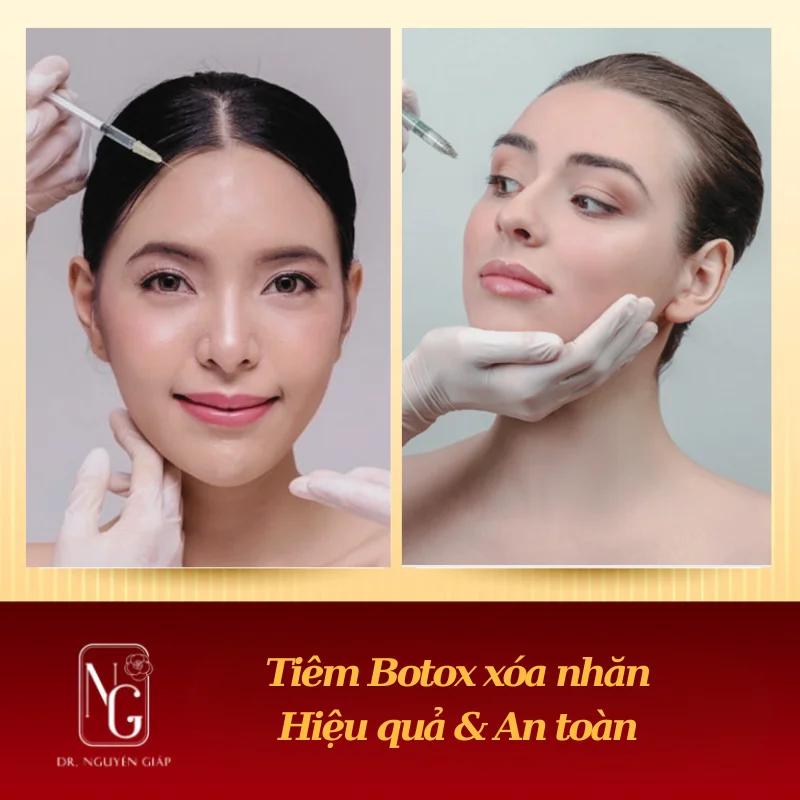 Tiêm Botox Xóa Nhăn là gì