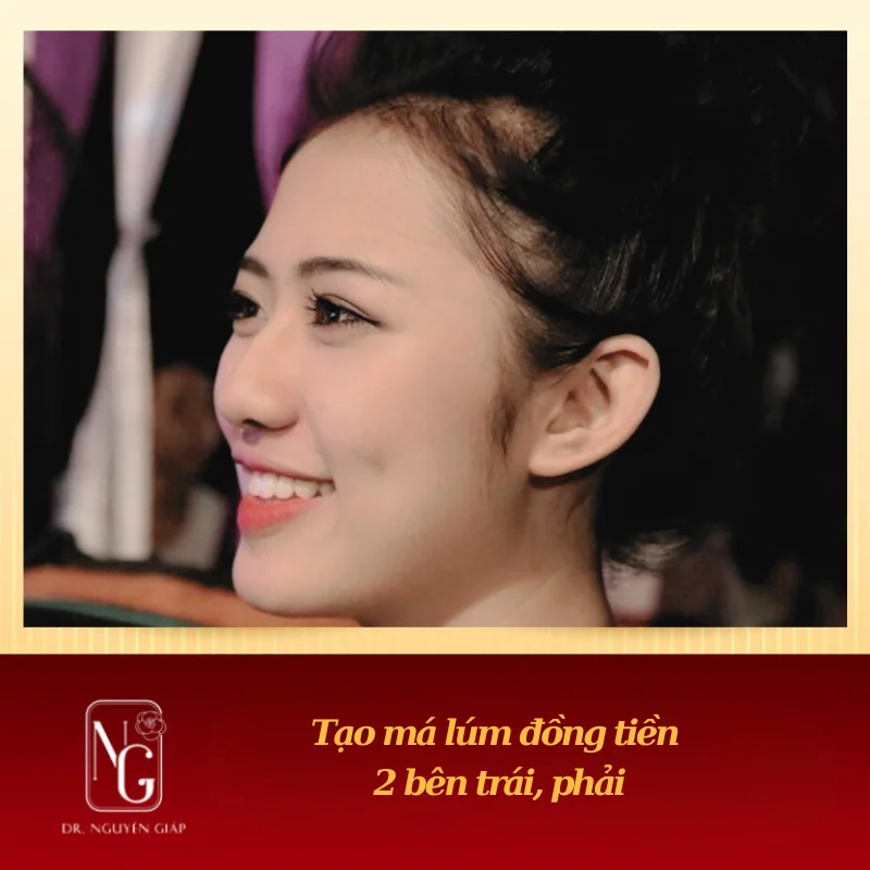 Phẫu thuật tạo má lúm đồng tiền