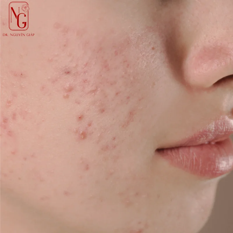 tac-dung-phu-khi-bo-sung-vitamin-a tac dung phu khi bo sung vitamin a