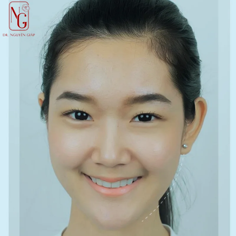 phau thuat cam v line