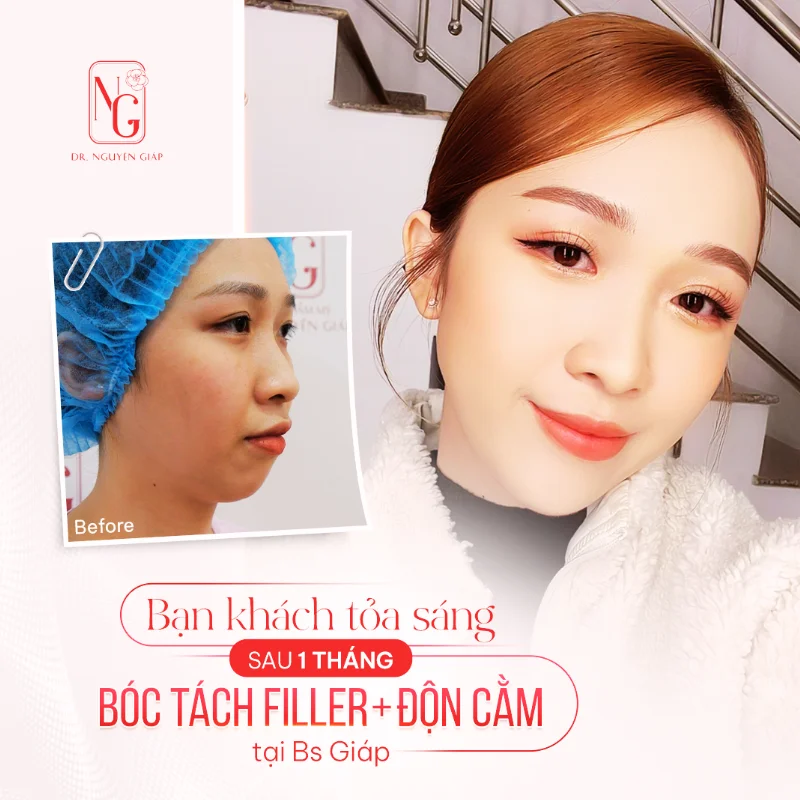 tao cam v line bang phuong phap don cam
